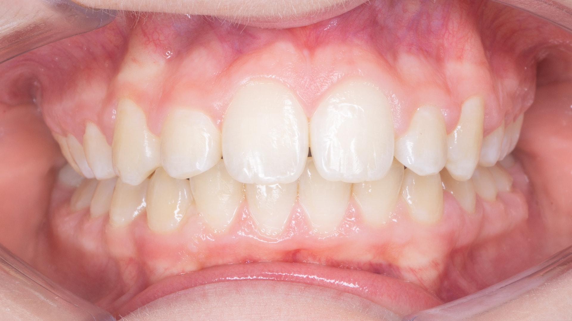 Before treatment, front view of teeth