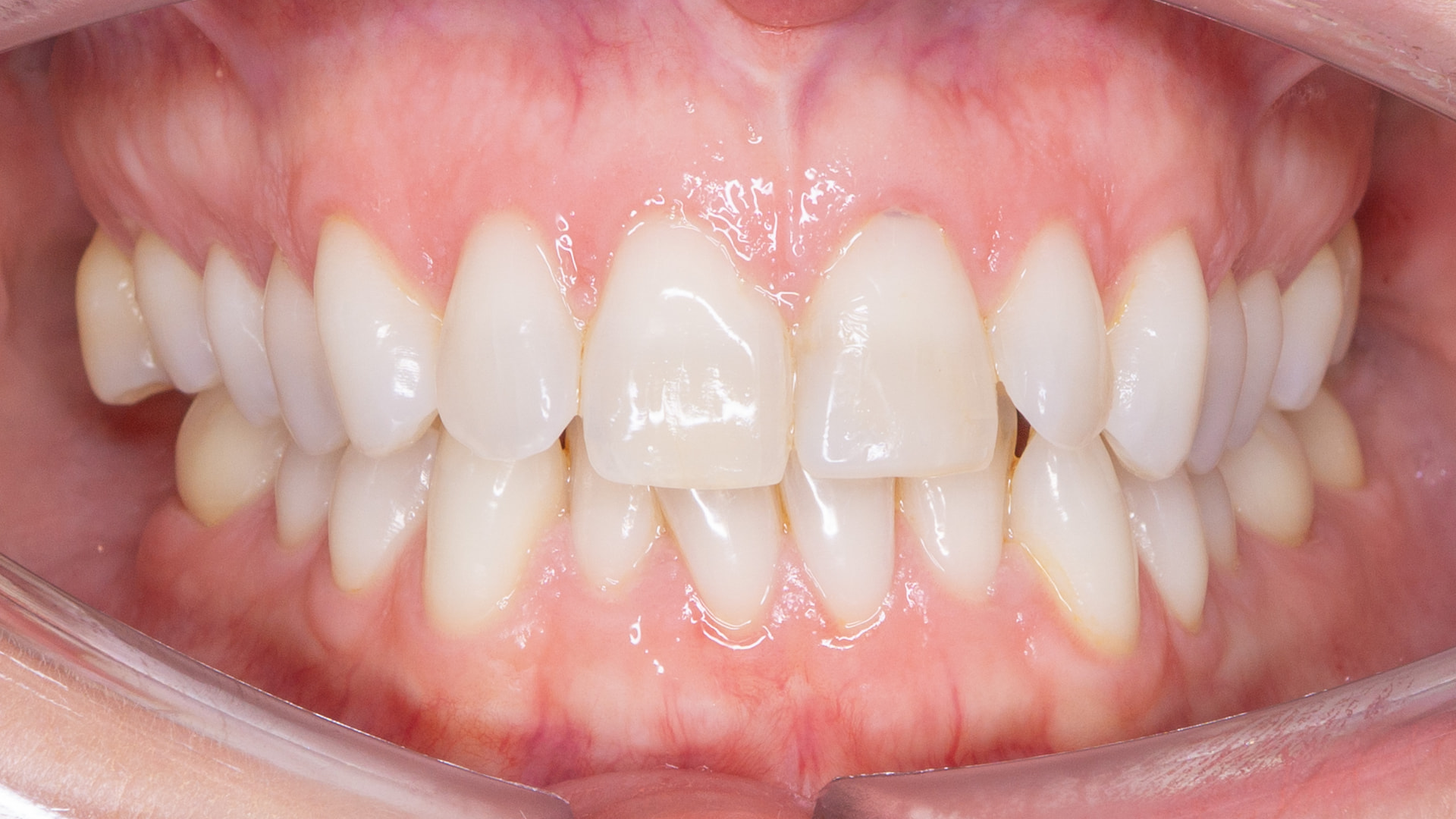 Before treatment, front view of teeth
