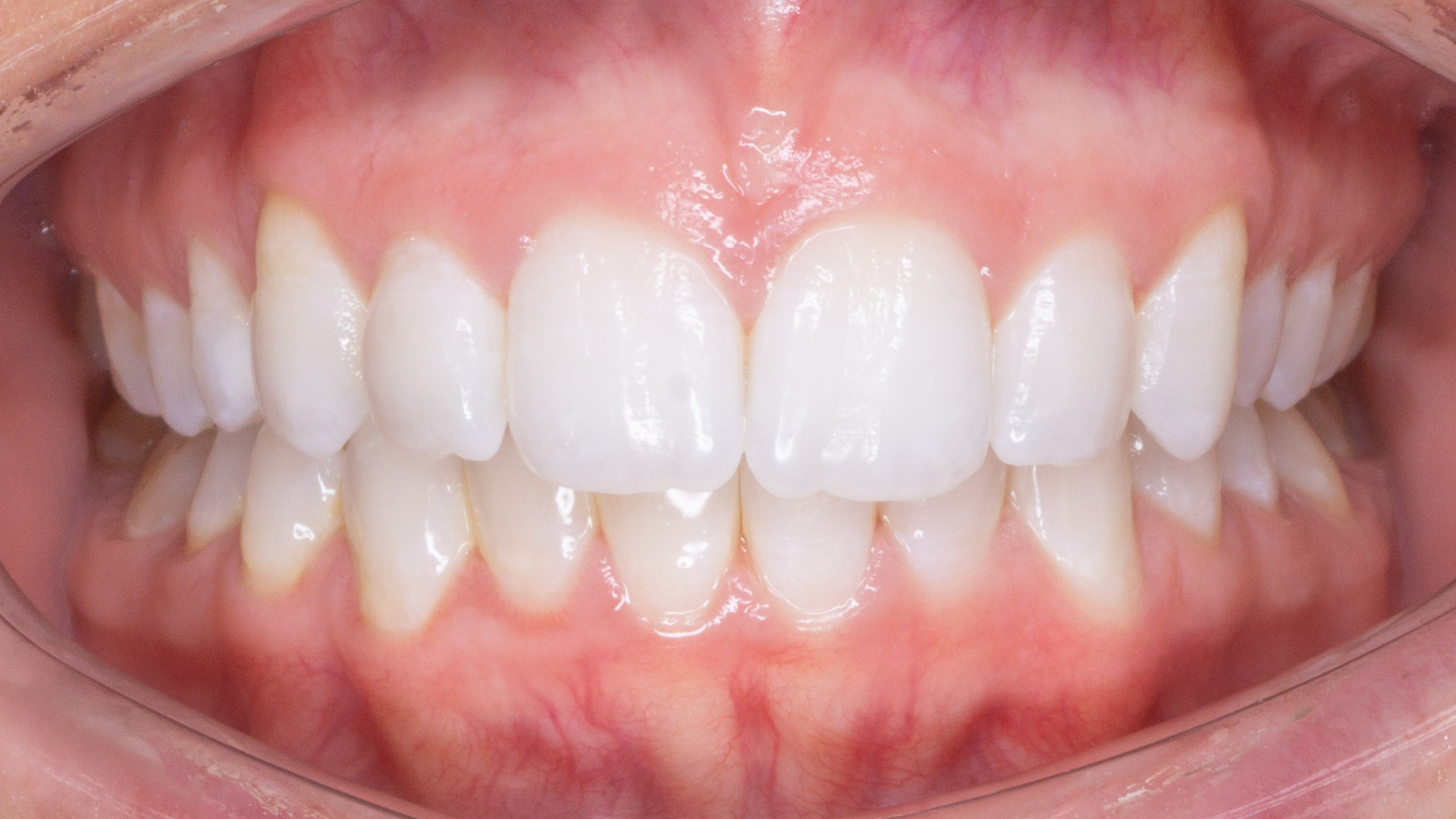 After treatment, front view of the finished smile