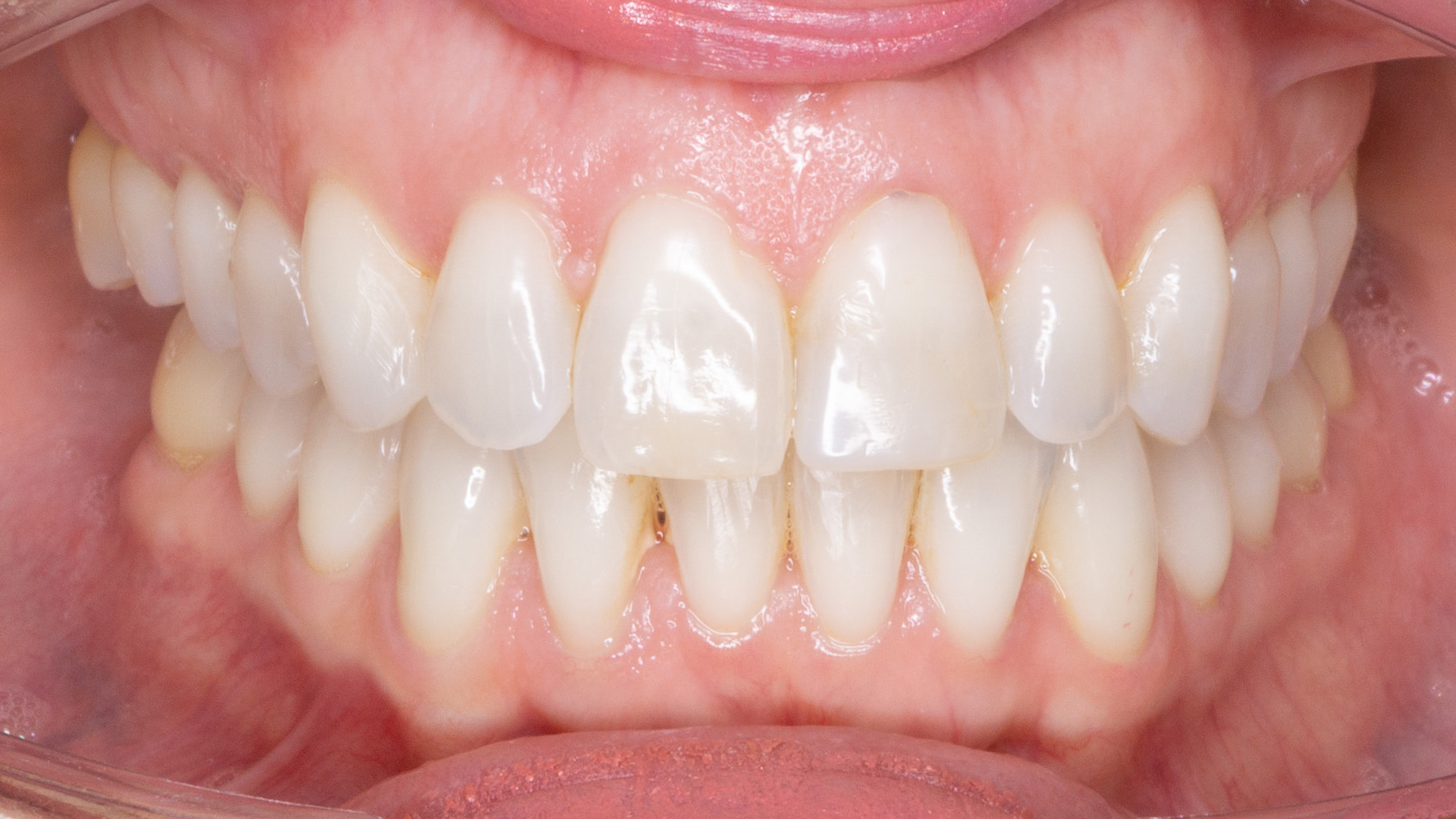 After treatment, front view of the finished smile